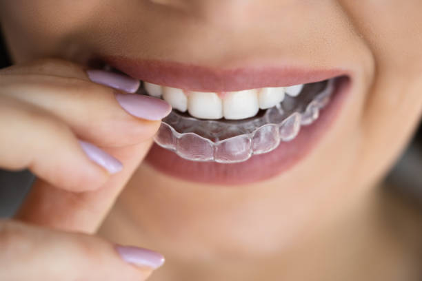 istock Clear Aligner Dental Night Guard 1429256189
