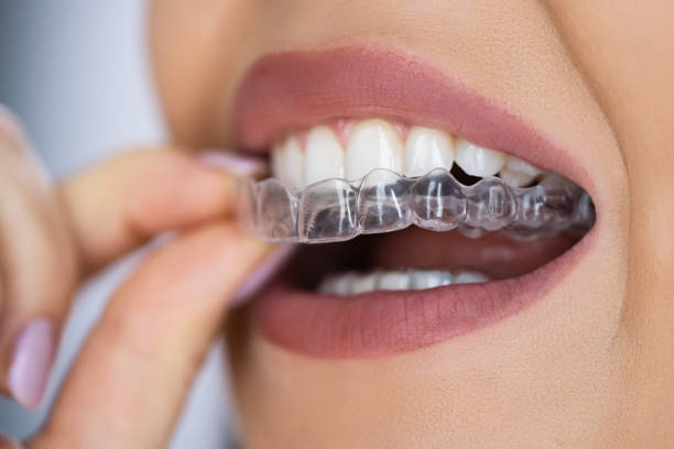 clear aligner dental nachtwache - zahnschiene stock-fotos und bilder