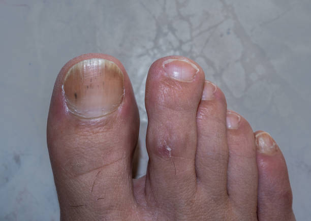 足の爪の真菌を持つ男の足の親指。 - fungus toenail human foot onychomycosis ストックフォトと画像