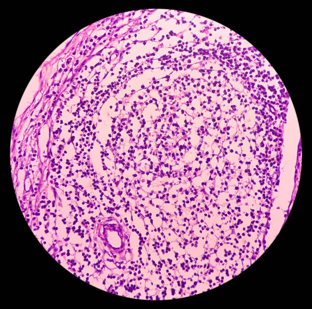 photomicrographie du ganglion lymphatique atteint de la maladie de hodgkin (lymphome), sclérose nodulaire. - hodgkins disease photos et images de collection