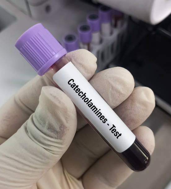 scienziato tenere campione di sangue per catecolamine - test, per verificare la presenza di tumori surrenali negli adulti. - phenethylamine foto e immagini stock