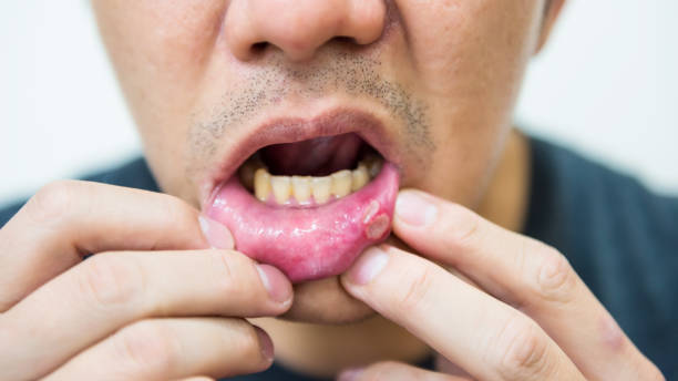 istock Painful aphtha ulcer man's mouth from accident or not enough sleep 1429674098