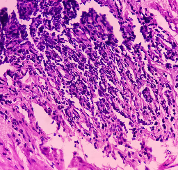 Tissue from rectum(colonoscopic biopsy):  Chronic nonspecific proctitis. Show rectal mucosa, IBD. Tissue from rectum(colonoscopic biopsy):  Chronic nonspecific proctitis. Show rectal mucosa, dense infiltration of lymphocytes, histiocytes and plasma cell in lamina propria. IBD. lamina propria stock pictures, royalty-free photos & images