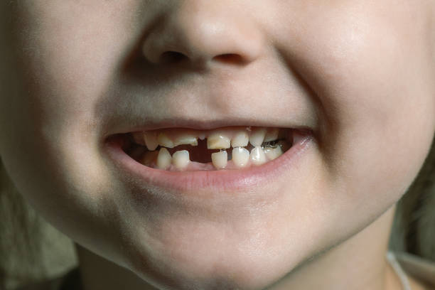 istock Children's mouth with fallen and broken milk teeth 1430102751