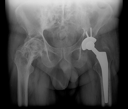 x-ray of hip and hip prosthesis implant with leg ligament