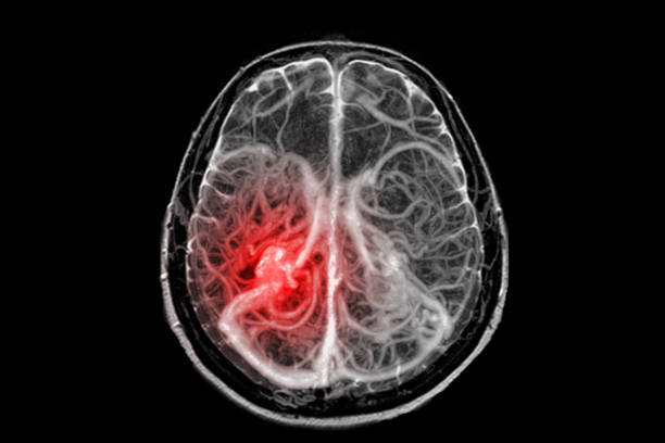 Fusion images of MRI and MRA Brain or Magnetic resonance angiography ( MRA ) of a cerebral artery in the brain view to evaluate stenosis and stroke disease. Fusion images of MRI and MRA Brain or Magnetic resonance angiography ( MRA ) of a cerebral artery in the brain view to evaluate stenosis and stroke disease. cerebrum stock pictures, royalty-free photos & images