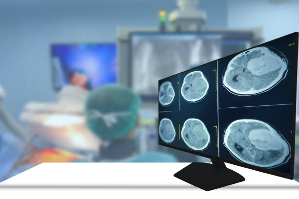 tomografia komputerowa mózgu znalezienie izodensji masy z źle zdefiniowanym marginesem i otaczającym obrzękiem w lewym płacie czołowym. glejak, przerzuty do mózgu. rozmyte tło sali operacyjnej. - brain surgery mri scanner cat scan oncology zdjęcia i obrazy z banku zdjęć