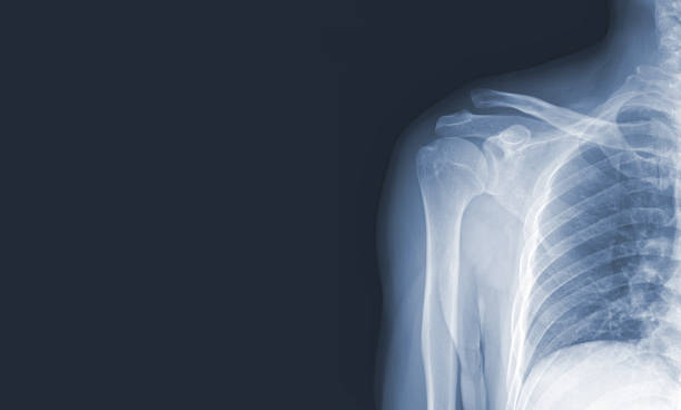 images radiographiques de l’articulation de l’épaule pour voir les blessures osseuses et tendineuses pour un diagnostic médical. concept d’image médicale et espace de copie. - x ray x ray image shoulder human arm photos et images de collection