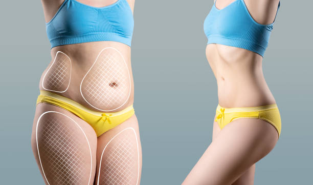 Tummy tuck, cellulite removal, woman's body before and after liposuction on gray background, plastic surgery concept, photos taken at different times after weight loss stock photo
