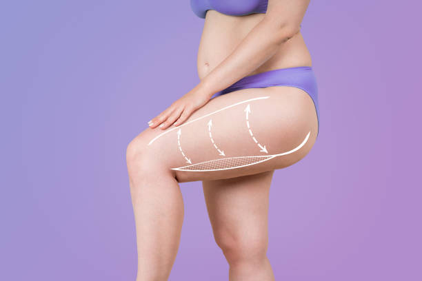 脚とお尻の脂肪吸引、脂肪とセルライトの除去コンセプト、塗装された手術ラインと矢印を備えた太りすぎの女性の体 - thigh ストックフォトと画像