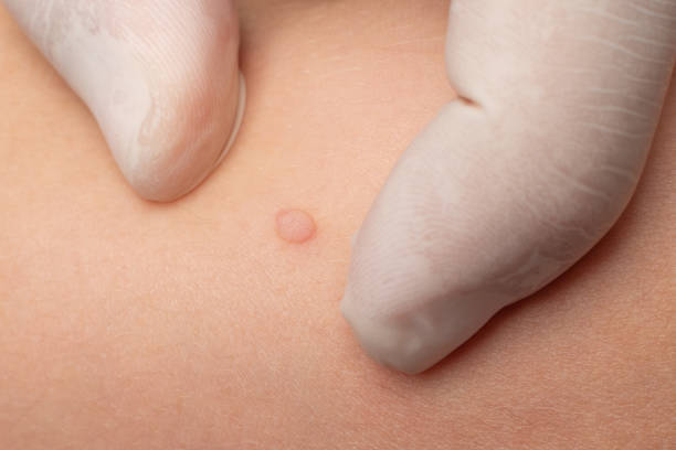 istock A doctor examines a wart on a child's body. 1430343327