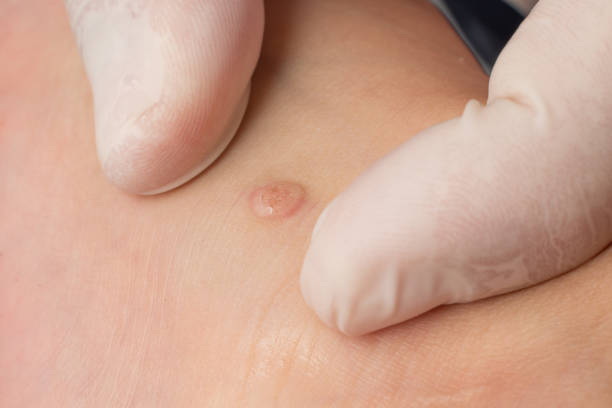 A doctor examines a wart on a child's body. A doctor examines a wart on a child's body, the doctor is wearing gloves. wart stock pictures, royalty-free photos & images