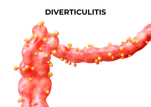 Diverticulitis is a disease that occurs when the diverticula of the large intestine become inflamed or infected, and may present an abscess or perforation stock photo