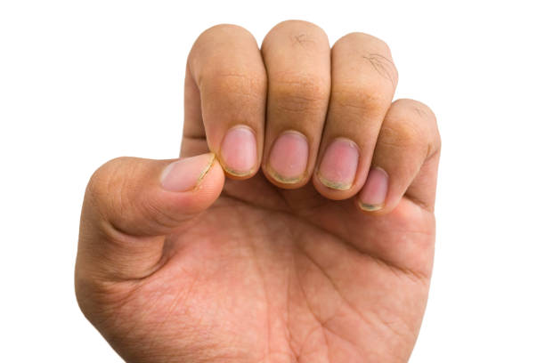 istock dirty nails hand on white background 1430560278