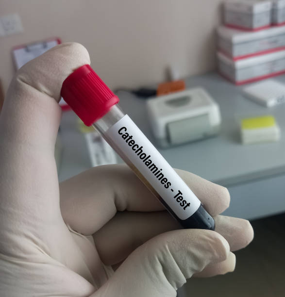 scienziato tenere campione di sangue per catecolamine - test, per verificare la presenza di tumori surrenali negli adulti. test di dopamina, noradrenalina, epinefrina. - phenethylamine foto e immagini stock