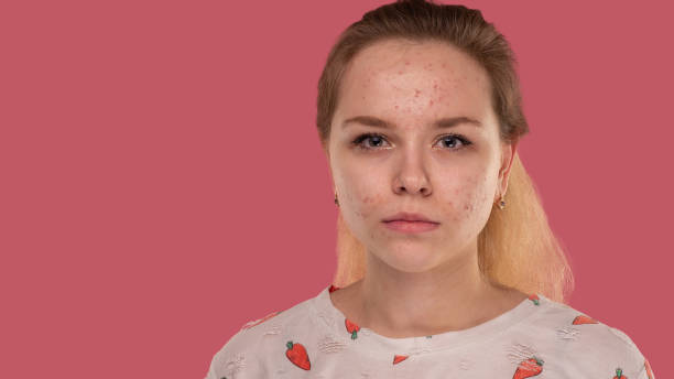 istock Teen girl with acne problem 1430648675