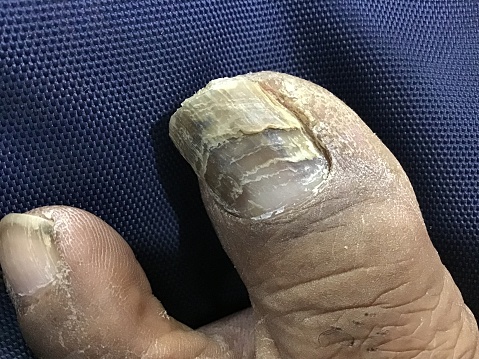 Fungal infection of the toenail.