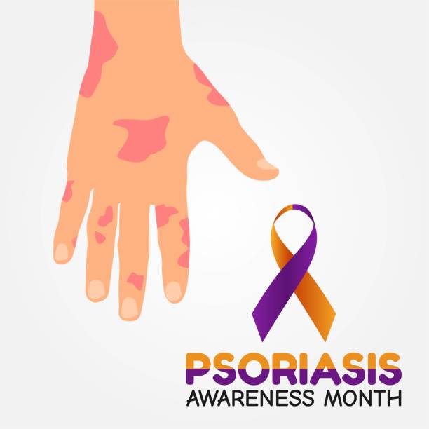 illustrations, cliparts, dessins animés et icônes de illustration vectorielle du mois de la sensibilisation au psoriasis. convient pour carte de vœux, affiche et bannière. - psoriasis