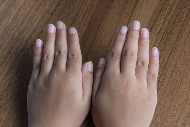 White Spots on Children's Nails, Due to Calcium Deficiency. This disease is called leukonychia.