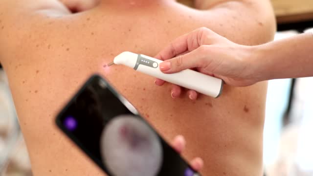 Dermatologist examines patient birthmark with dermatoscope and looks at result on smartphone