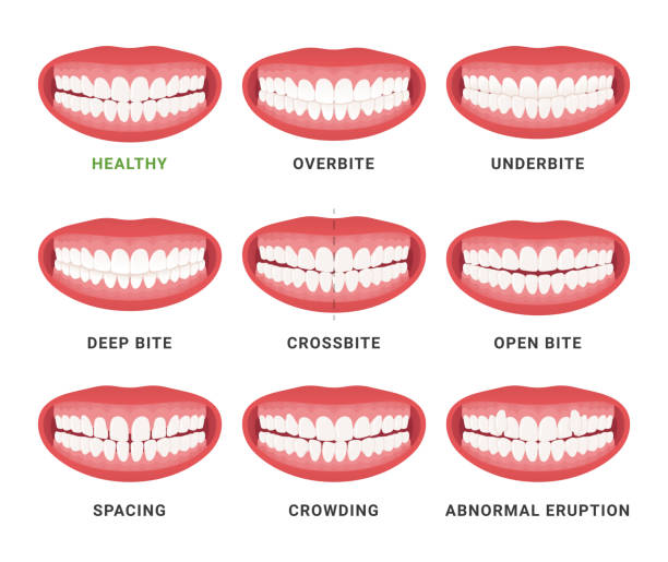 ilustrações, clipart, desenhos animados e ícones de mandíbulas bucais humanas médicas mordida ruim e esquema saudável com nomes definir vetor plana - dental cosmetic