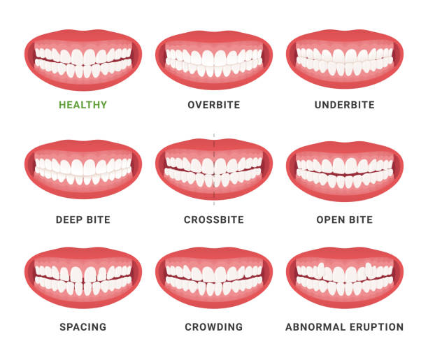 Human mouth jaws medical bad bite and healthy scheme with names set vector flat Human mouth jaws medical bad bite and healthy scheme with names set vector flat illustration. Orthodontist anatomical surgery correction dentistry disease overbite underbite crossbite spacing orthodontist stock illustrations