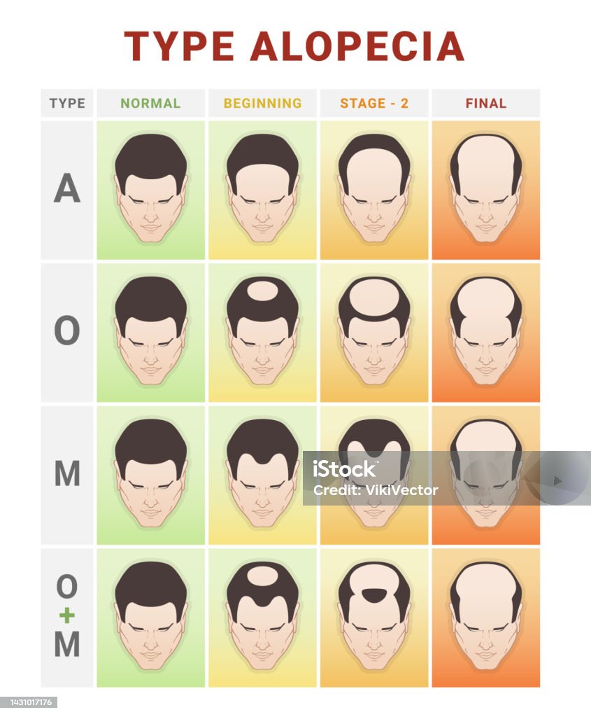Hair Loss Stages Infographic Medical Education Scheme Vector Flat Baldness  Types Info Chart Stock Illustration - Download Image Now - iStock