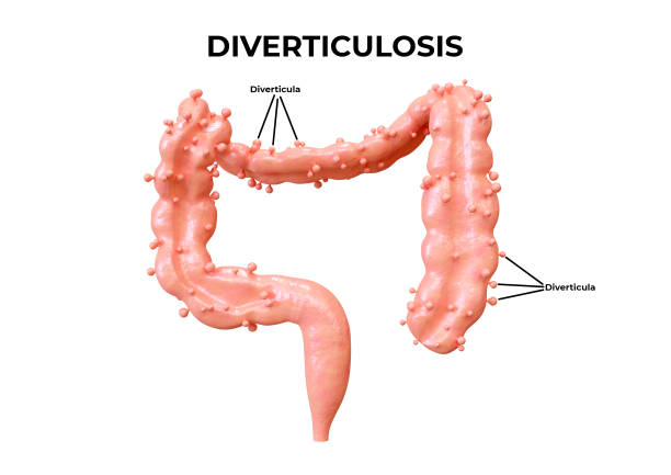 istock diverticulosis is a gastrointestinal disorder in which diverticula form in the intestine 1431134266