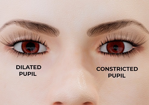 Miosis is a condition in which one or both pupils constrict, regardless of how much light enters the eye. 3D illustration