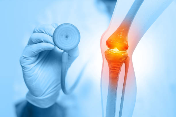 orthopaedics doctors examining human knee joints. osteoarthritis, rheumatoid arthritis, joint disease. knee joint and bone treatment. 3d illustration - osteoarthritis doctor medicine healthcare and medicine imagens e fotografias de stock