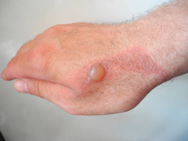 istock Horrible burns on male hand on gray background 1431576286