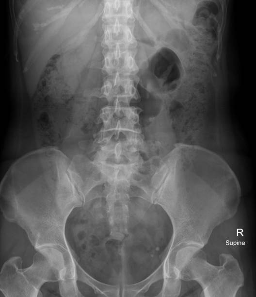 radiografía de película del abdomen de la mujer - cat scan abdomen medical scan x ray fotografías e imágenes de stock