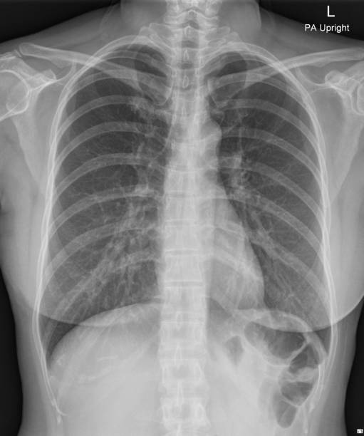 istock film x-ray woman chest 1431999852