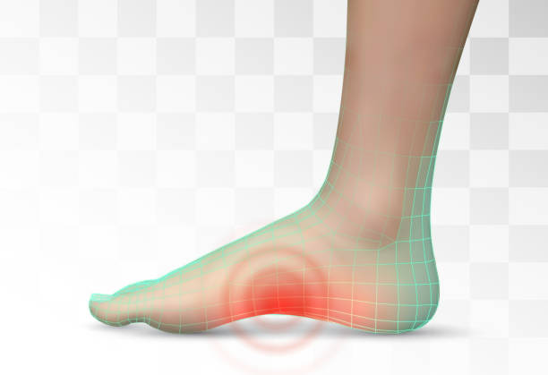 vector human foot.red spots of pain. ready element for medicine and orthopedics vector human foot.red spots of pain. ready element for medicine and orthopedics pes planus stock illustrations