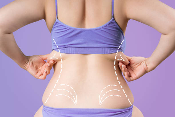 Back liposuction, fat and cellulite removal concept, overweight female body with painted surgical lines and arrows stock photo