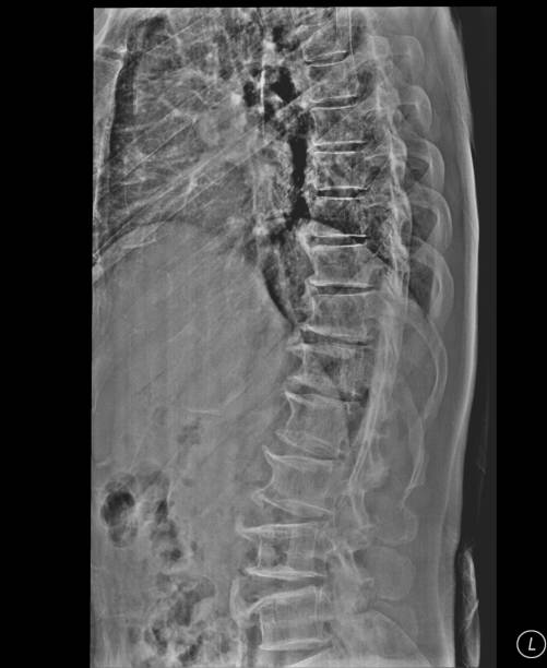 脊柱側弯症フィルムx線腰椎 - orthopedic equipment osteoporosis x ray human spine ストックフォトと画像