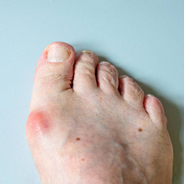 istock inflamed joint with Hallux valgus on foot.. 1432264566