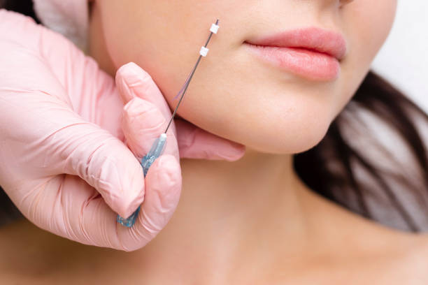 istock Face lifting PDO Suture operation. innovative technique of New thread lift, cosmetologist preparing to do procedure to female client, select the appropriate thread option 1432417805