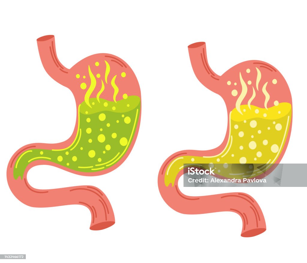 Human Stomach Set Gastritis And Acid Reflux Indigestion Vomiting human-stomach-on-fire-heartburn-gastritis-and-acid-reflux
