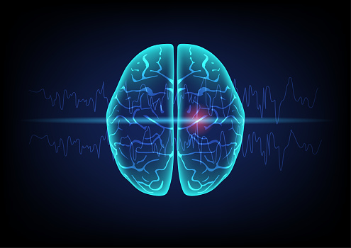 Illustration of human brain and brain wave on technology background. Concept of focal seizure.