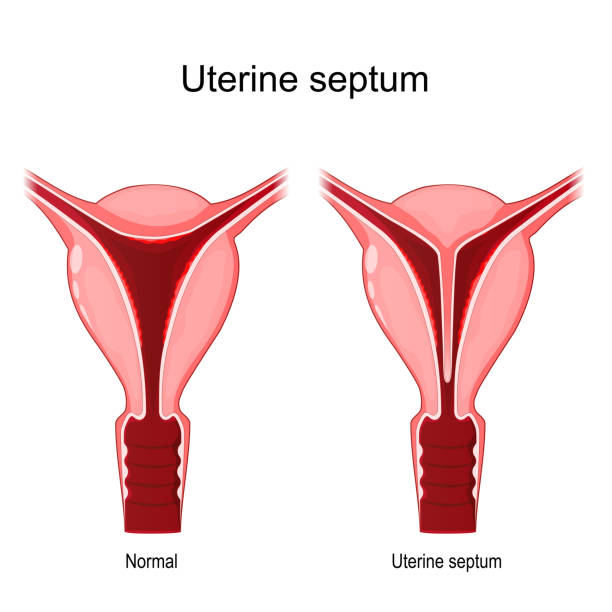 Uterine septum. Uterine septum. Comparison and difference between normal and abnormal uterus. female reproductive system. uterine malformations. Vector illustration septum stock illustrations