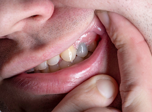 A dark tooth in a man's mouth after injury. Tooth decay by caries, dentistry.