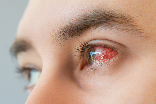 Primer plano de los ojos marrones inyectados en sangre del macho y enrojecimiento con los vasos. Concepto de queratitis, inflamación y oftalmología photo