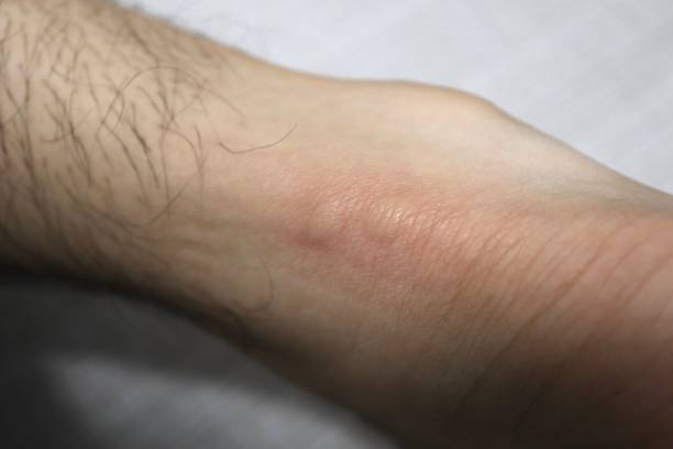 istock Two insect bites near the heel. 1432861944