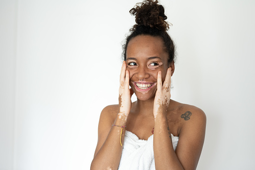Beautiful young brazilian woman with vitiligo posing with towel, skin care and genetic pigmentation concepts, smiling people and body positive concept, white background