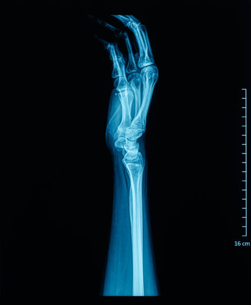 ludzki palmowy film rentgenowski - metacarpal zdjęcia i obrazy z banku zdjęć