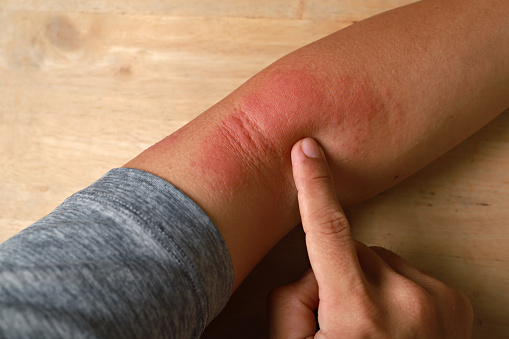 Rash is a symptom that causes the affected area of skin to turn red and blotchy and to swell.