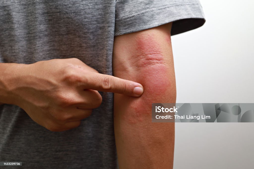 Close up of man having itch caused of a red rash Rash is a symptom that causes the affected area of skin to turn red and blotchy and to swell. Eczema Stock Photo
