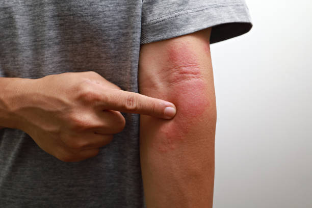 Close up of man having itch caused of a red rash stock photo
