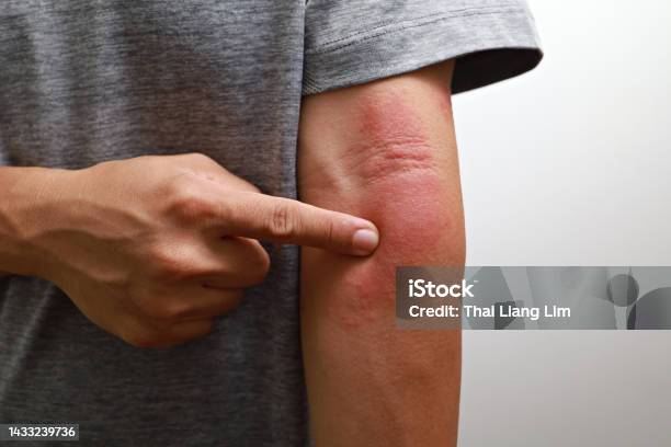 Close Up Of Man Having Itch Caused Of A Red Rash Stock Photo - Download Image Now - Eczema, Psoriasis, Dermatitis
